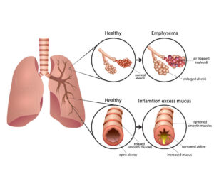 Cut Your Risk of COPD with Omega-3